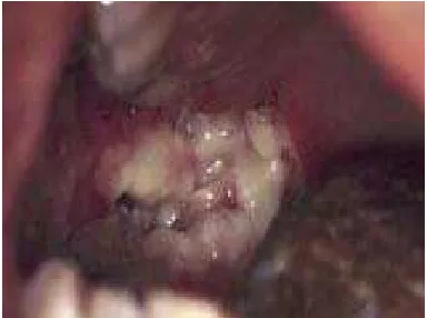 Gambar 14. Ulserasi Neutropenik  