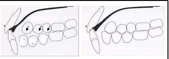 Gambar 14. Fase pendukung dengan anterior inclined plane.10 