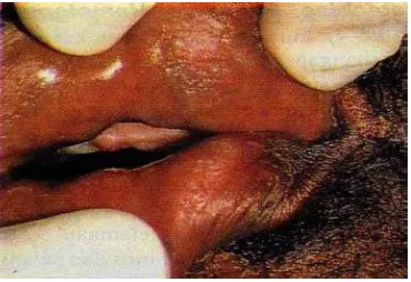 Gambar 1. Keratosis rokok pada mukosa bibir24 