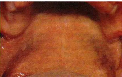 Gambar 2.Melanosis perokok24