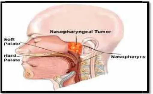Gambar 1. Lokasi anatomis kanker kepala dan leherGambar 1. Lokasi anatomis kanker kepala dan leherGambar 1