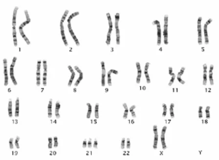 Gambar 1. kromosom pada sindroma Down11