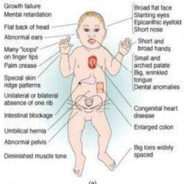 Gambar 2. Keadaan tubuh anak sindroma down 12