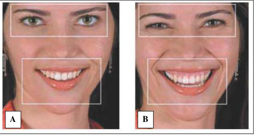 Gambar 1. Tipe dasar senyum. (A) Senyum sosial dan (B) senyum spontan8 
