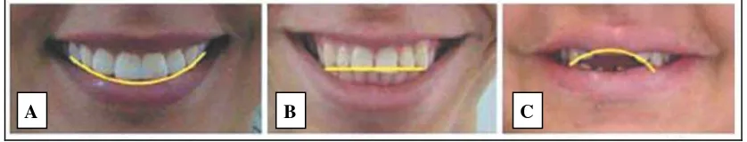 Gambar 2. (A) Consonant smile, (B) straight smile dan (C) reverse smile21 