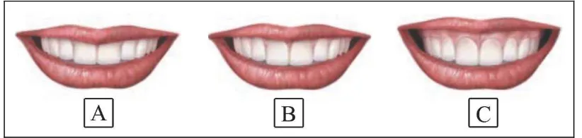 Gambar 3. (A) Low smile, (B) average smile, dan (C) high smile23 