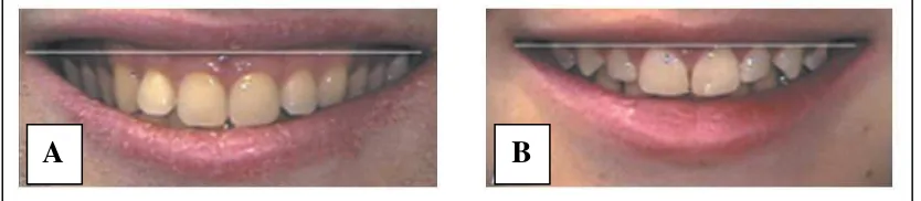 Gambar 4. (A) Gummy smile dan (B) non-gummy smile12 