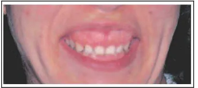 Gambar 5.  Perbedaan panjang bibir atas. (A) Panjang bibir ideal dan (B) panjang bibir yang tidak estetis28 