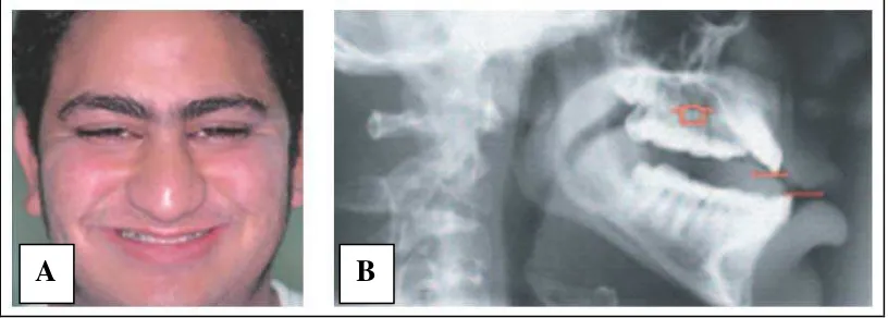 Gambar 7.  Low smile karena pengaruh tinggi vertikal maksila. (A) Foto profil dan (B) foto sefalometri lateral28 