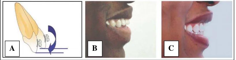 Gambar 8. Pengaruh inklinasi insisivus terhadap senyum. (A) Perubahan inklinasi insisivus maksilaris dapat mempengaruhi tampilan senyum, (B) tampilan sagital insisivus maksilaris yang sedikit proklinasi, dan (C) incisor display yang bertambah setelah insisivus maksilaris ditegakkan29 