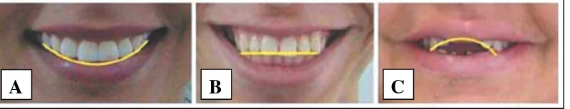Gambar 10. Tipe senyum berdasarkan smile arc. (A) Consonant smile, (B) straight smile, dan (C) reverse smile21 