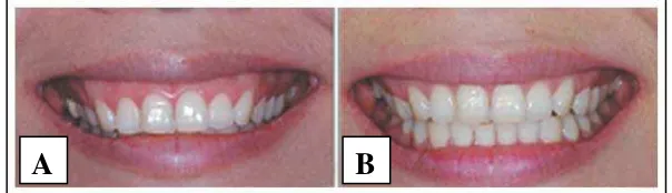 Gambar 11. Tipe senyum berdasarkan incisor display. (A) High smile, (B) average smile, dan (C) low smile21,33 
