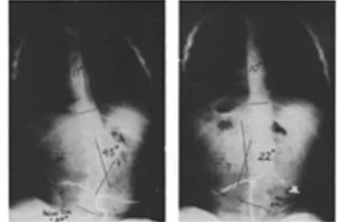 Gambar 1.  Spastik diplegia.