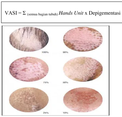 Gambar  2.1  Gambar  panduan  yang  telah  distandarisasi  untuk  memperkirakan  derajat pigmentasi pada vitiligo (dikutip dari Hamzavi dkk., 2004)