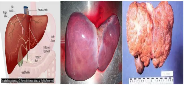 Gambar 2.1 Anatomi Hati   Gambar 2.2 Hati Normal    Gambar 2.3 Kanker Hati 