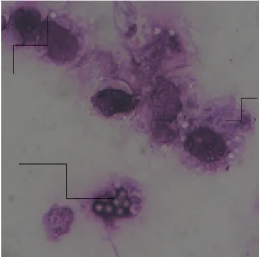 Gambar 2. Makrofag yang sedang memfagosit partikel latex (panah putih)                             Panah merah = partikel lateks
