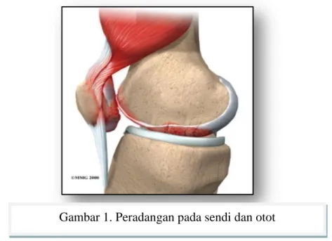 Gambar 1. Peradangan pada sendi dan otot 