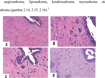 Gambar 2.11.  Gambaran mikroskopis tumor phyllodes jinak dengan pseudoangiomatous stromal hyperplasia dan stromal giant cell.5 A