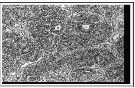 Gambar E.3. Tumor terdiri dari komponen jaringan blastema, epitel tubular, dan jaringan penyam- penyam-bung fibrosa