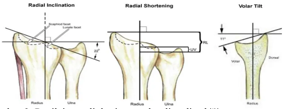 Gambar 2. Penilaian radiologi normal radius distal. (4) KLASIFIKASI RADIUS DISTAL FRAKTUR 