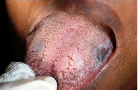 Figure 1. White anular striae with a central area of brownishhyperpigmentation and erythematous background on the right (A)and left (B) buccal mucosa, which also extended to buccal sulcus.
