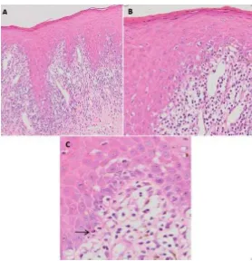 Figure 3. (A) Oral epithelium exhibits basal cells liquefaction degeneration with a band-likewithin the inflammatory cells, (C) Civatte bodies (arrow) (H&E, original magnification Ax10,inflammatory infiltrate in the lamina propria, (B) Scattered melanin in continence observedBx20, Cx40).