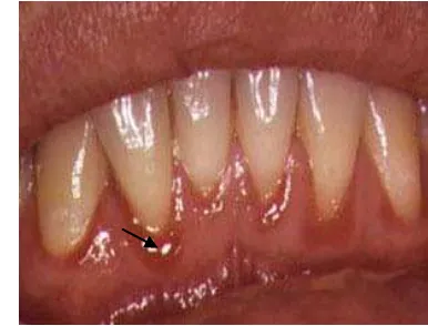 Gambar 4.  Eritema Linear Gingiva    (http://www.hivdent.org/_PictureGallery_/Images/linear_gingival_erythema1.jpg) <15 Mei 2009> 
