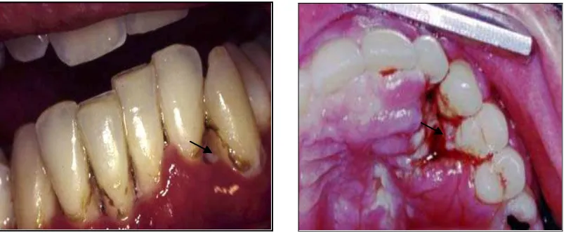 Gambar 6.  Necrotizing Ulcerative Periodontitis  (http://www.hivdent.org/_Picture Gallery_/Images/hds039.jpg) 15 Mei 2009  
