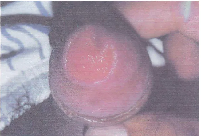 Gambar 3 Uretritis non spesifik.Gejala lebih ringan bila dibandingkan dengan 