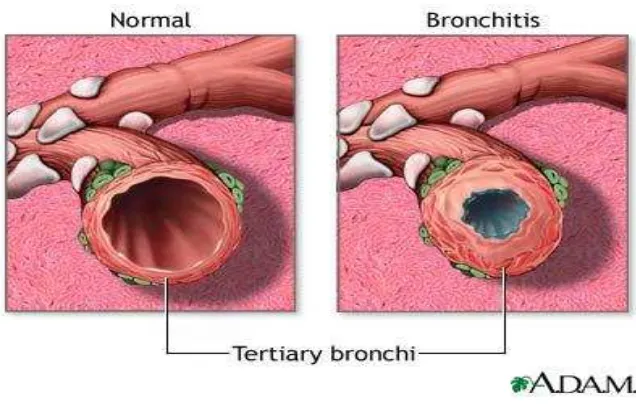 Gambar 2.1 Gambaran bronki normal dengan dengan bronkitis 