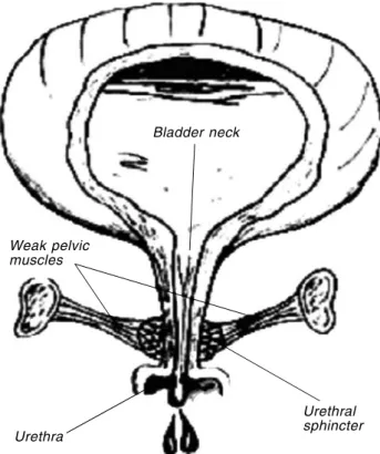 Gambar 1.  Inkontinensia urin karena leher kandung kemih dan uretra tidak menutup sempurna disertai dengan  kelemah-an otot dasar pelvis 1