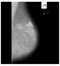 Gambar 1. Citra mammogram 