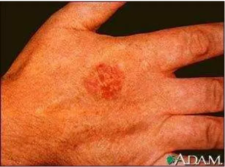 Gambar 2.2 Keratosis arsenik pada telapak tangan 