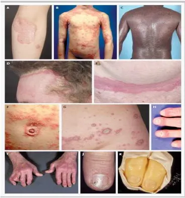 Gambar 2.2. : Karakteristik kulit pada Psoriasis vulgaris. Sumber  : Schön, M.P., Boehncke, W.H., 2005
