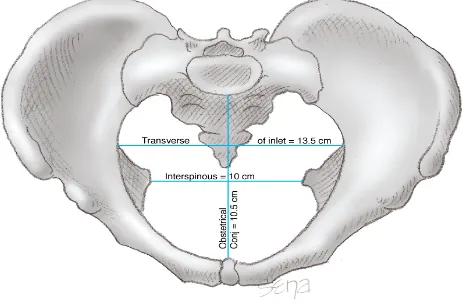 Gambar 2.4. Jenis-jenis plasenta previa. A: Marginal; B: Parsial; C: Totalis 