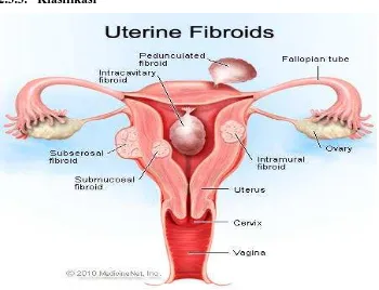 Gambar 2.3. Klasifikasi leiomioma uterus (Stoppler, 2010) 