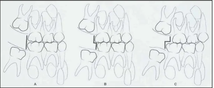 Gambar 6. Tiga tipe hubungan molar pertama permanen: (A) 