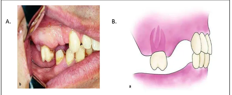 Gambar 1. Gigi posterior yang tinggal sendiri mengalami 
