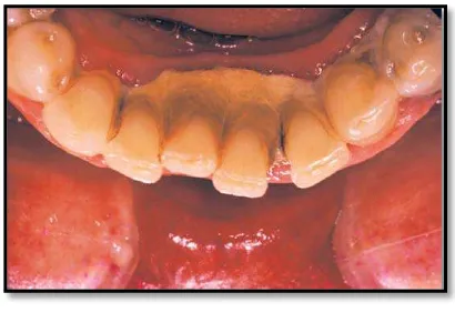 Gambar 1. Kalkulus supragingiva pada     permukaan lingual gigi anterior     rahang bawah1 