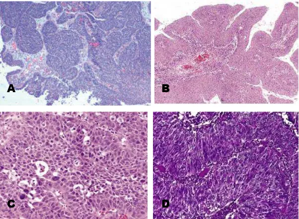 Gambar 2.8 Nonkeratinizing SCC. A dan B. Pembesaran kecil tampak struktur sarang-sarang dan papilar