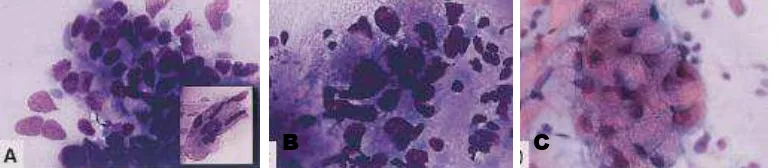 Gambar 2.10  B A. Primary ITACs, sel tumor dengan sitoplasma sedang, dan sel kolumnar (Inset)