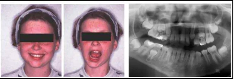 Gambar 9. (a) Hemifacial Microsomia, (b) Foto rontgen pada penderita        Hemifacial Microsomia22 