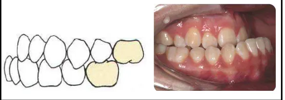 Gambar 18. Maloklusi Klas III Angle3,8 