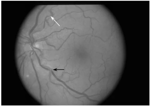 Gambar berdasarkan klasifikasi retinopati hipertensi menurut Wong dan 