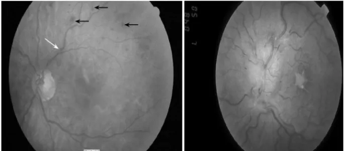 Gambar 2.2 (kiri) Retinopati hipertensi derajat sedang: perdarahan retina (panah hitam), penebalan arteri vena (panah putih), penyempitan menyeluruh arteriol retina.Gambar 2.3 (kanan) keganasan retinopati yang dipercepat : penebalan diskus optic, perdaraha