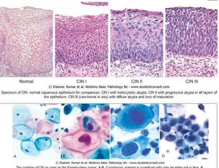 Gambar 2.6 Patogenesis Kanker Serviks (Kumar, 2007). 