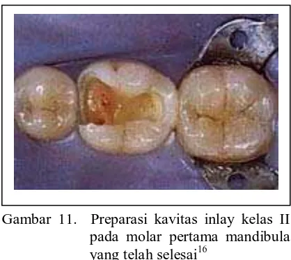 Gambar 11.  Preparasi kavitas inlay kelas II pada molar pertama mandibula yang telah selesai16 