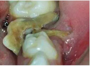 Gambar 4. Fistula di sisa akar gigi 85 dan pada gigi 261,30