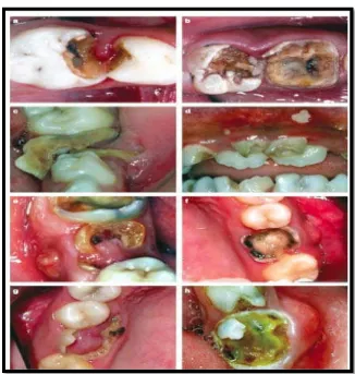 Gambar 2. (a dan b) Keterlibatan pulpa (P), kamar pulpa terlihat atau struktur koronal gigi telah hancur karena karies dan hanya  akar; (c dan d) Ulserasi (U), traumatik ulser pada jaringan lunak (lidah dan mukosa) karena gigi atau sisa akar; (e dan f) Fistula (F), saluran sinus mengeluarkan nanah dari abses dan terbukanya kavitas oral; (g dan h) Abses (A), abses dentoalveolar9 