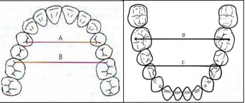 Gambar 4. Jarak interpremolar  diukur dari titik terdistal cekung mesial pada oklusal gigi premolar pertama maksila ke titik yang sama pada sisi yang berlainan (A), jarak intermolar diukur dari titik cekung mesial pada permukaan oklusal pada gigi molar pertama maksila ke titik yang sama pada sisi yang berlainan (B), jarak interpremolar diukur dari titik kontak antara gigi premolar satu dan gigi premolar dua mandibula ke titik yang sama pada sisi yang berlainan (C), jarak intermolar diukur dari titik puncak cusp mesiobukal molar satu permanen mandibula ke titik yang sama pada sisi yang berlainan (D).32,6,20 